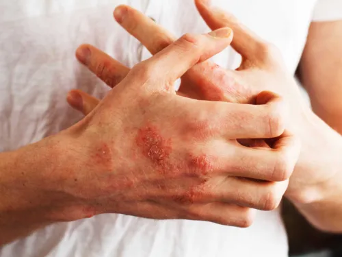 Hand mit Schuppenpflechte