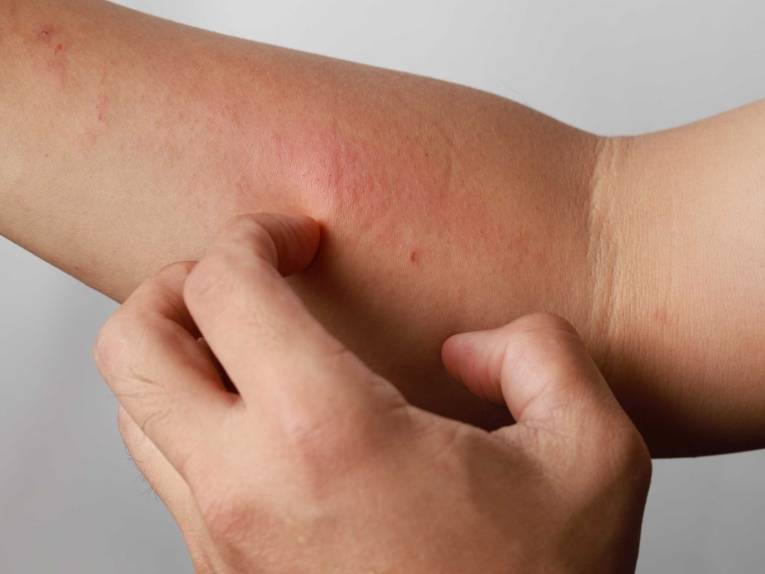 Arm mit Neurodermitis