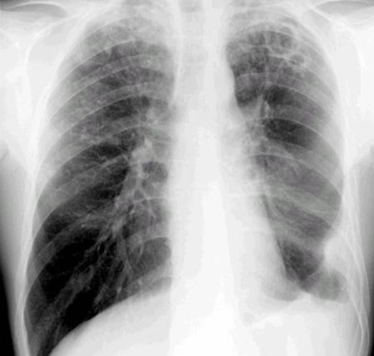 Röntgenbild fortgeschrittene Lungentuberkulose - Zerstörung des Lungengewebes