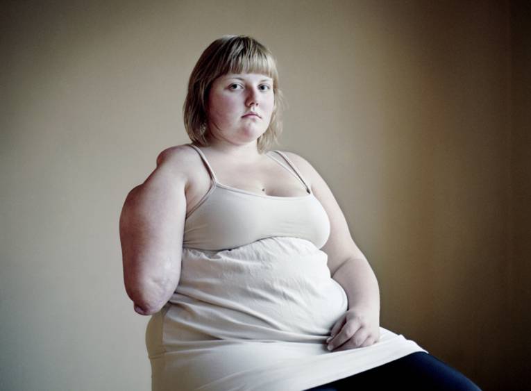 Ein Mädchen, dessen einer Arm amputiert ist