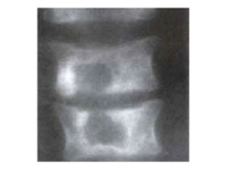 Röntgenbild eines mit Tuberkulose infizierten Wirbelkörpers