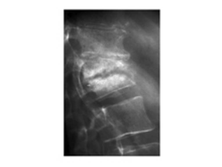 Röntgenbild eines mit Tuberkulose infizierten Halswirbelkörpers